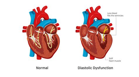 causes of lv diastolic dysfunction|does diastolic dysfunction go away.